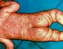 dieu tri kawasaki